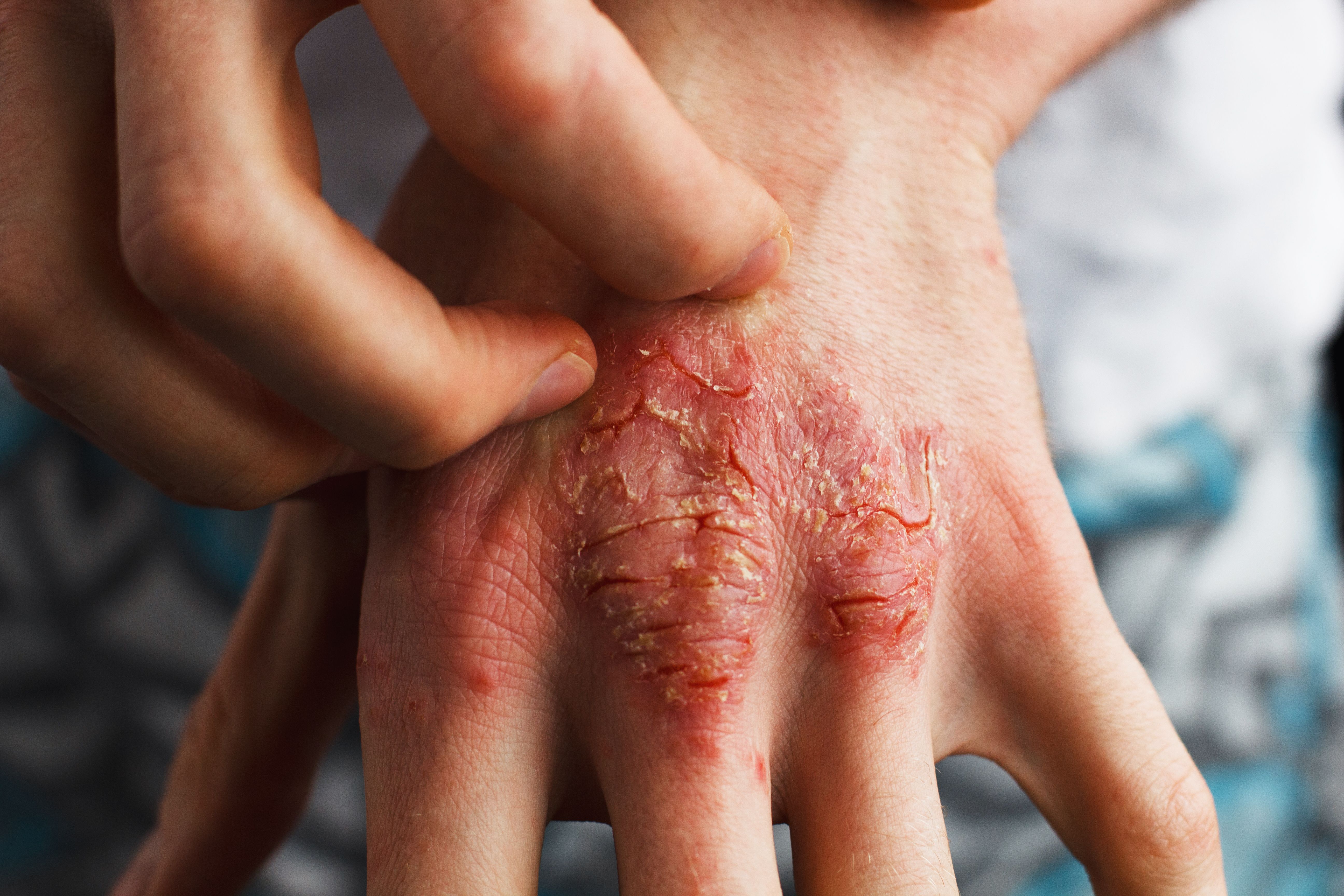 Hand with psoriasis | Ольга Тернавская - stock.adobe.com