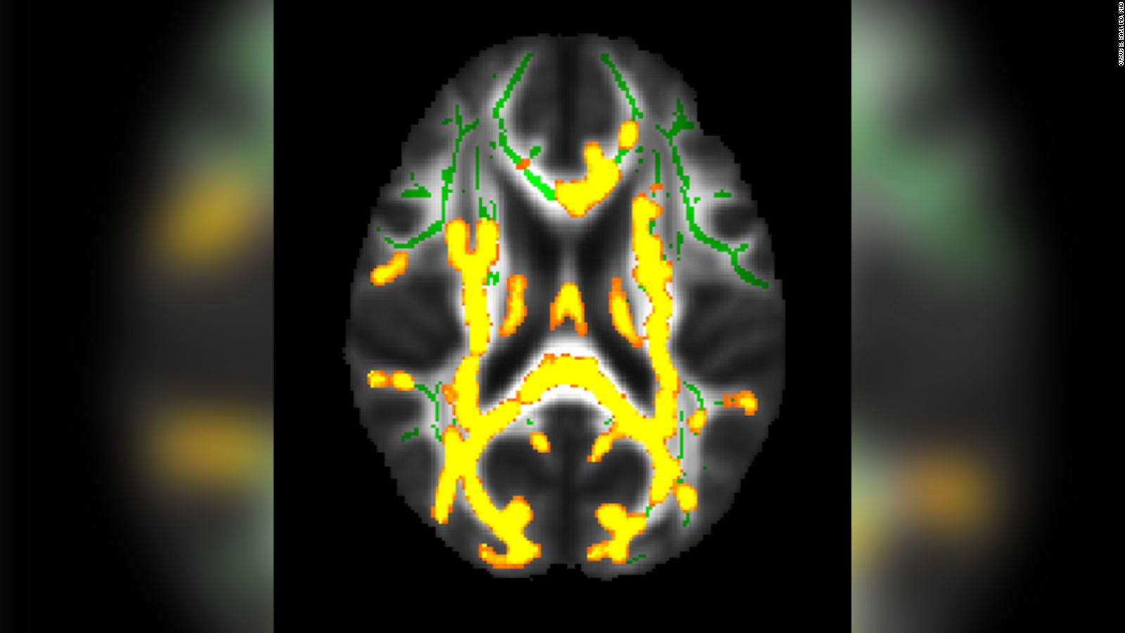 Investigadores hallan nueva forma de Alzheimer genético