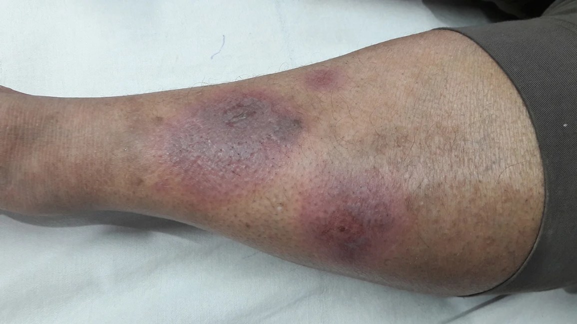 Erythema nodosum on a person's leg