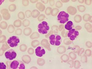 HTLV-1 leukaemic cells. Credit: Blood Journal. doi: 
https://doi.org/10.1182/blood-2009-09-245233
