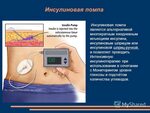 Порт для инсулина. Аппарат для автоматического вкалывания инсулина. Аппарат инсулиновая помпа. Инсулиновая помпа на 2 инсулина. Инсулиновая помпа с автоматическим измерением сахара.