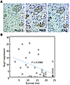 Nupr1, RelB, and IER3 expression in human PDAC.