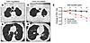 Radiographic and pulmonary function studies of telomerase muta