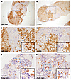 Spatial relationship between intrahepatic viral nucleic acids (HBV DNA, RNA