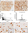 Highly complex distribution of HBsAg, HBcAg, and viral DNA.