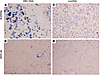 Distribution of HBV DNA and cccDNA before and after adeforvir therapy.