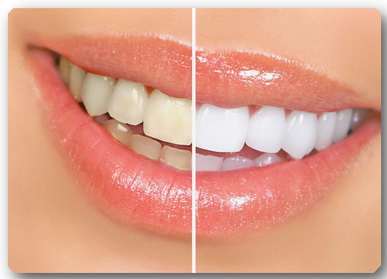 clareamento-dental (387x279, 33Kb)