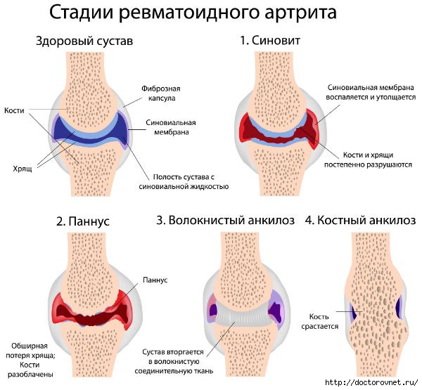 1420649955_KARTOFEL_NA_KEFIRE_PROTIV_ARTRITA (600x555, 140Kb)