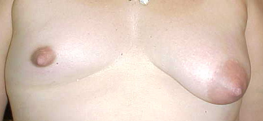 Exemple de pits d'una dona amb la síndrome de Poland