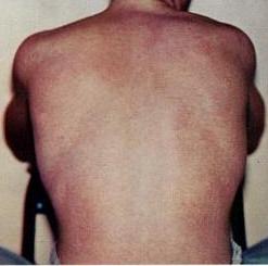 عکس پوست پشت یک فرد با حساسیت‌های نشان‌دهنده تب دنگی