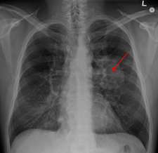 Klasický rentgenový snímek hrudníku vykazující karcinom plic (označen šipkou)