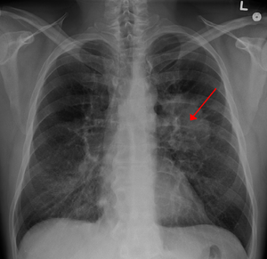 Рентгенограма органів грудної порожнини: рак легені - затемнення з нерівним та нечітким контуром (позначено стрілкою).