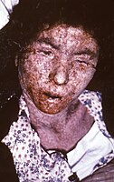 Cildi geç evre konfluent makülopapüler skar özellikleri gösteren İtalyan bir kadın çiçek hastası, 1965.