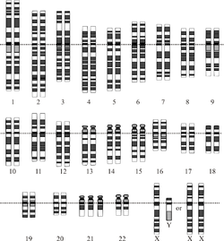 Chromosomes in متلازمة داون, the most common human condition due to aneuploidy. Notice the three copies of chromosome 21 in the last row.