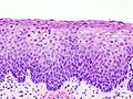 CIN II（II级）不典型增生细胞占宫颈上皮层的下部2/3，病变部分与正常细胞层分界清楚。