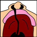 Fisura palatina y labial completa unilateral