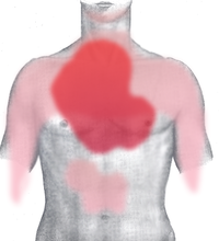 Схематична вентрална и дорзална диаграма на зоната на болка при наличие на инфаркт на миокарда (тъмночервено: типична област на болка, светлочервено: други възможни области).