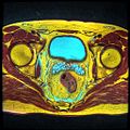 Sjeminske vezikule vidljive na MRI snimku kroz karlicu. Veliko područje cijan boje je mjehur, a lobulirane manje strukture ispod njega su vezikule.