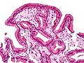 Micrografia da colesterolose da vesícula biliar.
