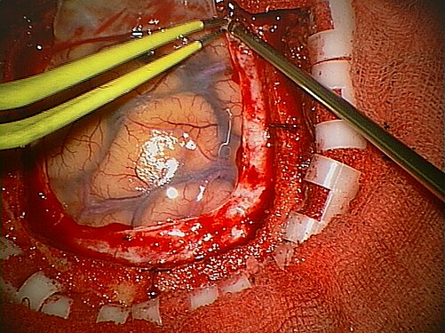 Detall d'una craniotomia