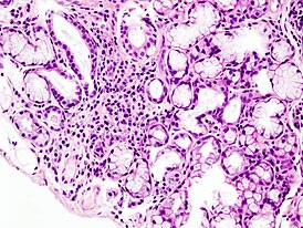 Гистологическая картина локальной лимфоидной инфильтрации малой слюнной железы при синдроме Шёгрена. Биопсия губы. Окраска гематоксилин-эозином