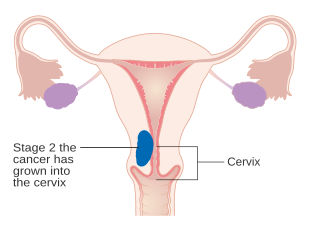 II 병기의 자궁내막암의 그림