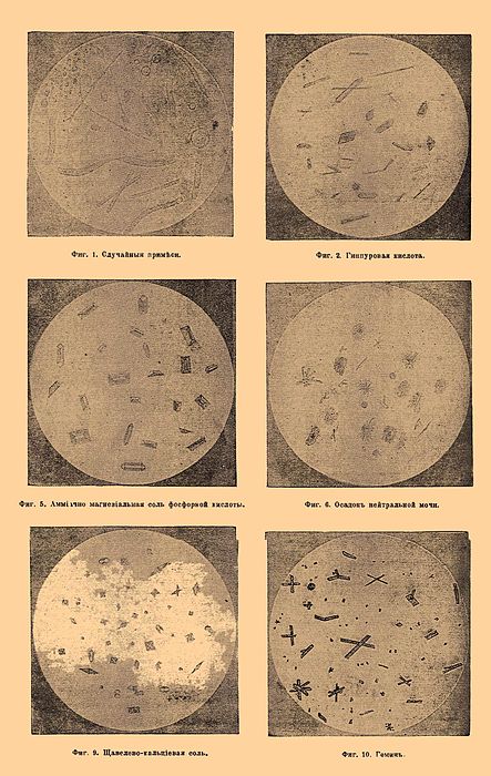 Фиг. 1. Случайные примеси. Фиг. 2. Гиппуровая кислота. Фиг. 5. Аммиачно-магнезиальная соль фосфорной кислоты. Фиг. 6. Осадок нейтральной мочи. Фиг. 9. Щавелево-кальциевая соль. Фиг. 10. Гемин.