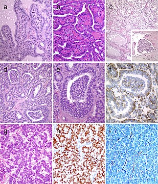 Hyperfunctioning follicular adenoma typically shows follicles with papillary infoldings and bubbly, pale colloid with peripheral scalloping (a). Non-hyperfunctioning adenomas with papillary hyperplasia usually show a more predominantly papillary pattern without vacuolated cytoplasm and scalloping colloid (b). Rare hyperfunctioning follicular tumors (c) can show capsular and/or venous invasion (inset); the nuclei are very clear which may be associated to hyperfunctioning. The glomeruloid pattern in this follicular thyroid carcinoma (FTC) included follicles with round to oval tufts growing within, at times supported by a fibrovascular core mimicking the renal glomerulus (d and e); empty follicles were lined by columnar cells with marked pseudostratification, and positivity for CK18 was detected (f). FTC (g) with TTF1 expression (h) and very focal expression of thyroglobulin i[7]