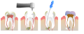 Root Canal Illustration