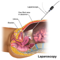 Laparoscopy of the uterus and fallopian tubes
