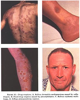Примеры лекарственной токсидермии: (А) — синдром Лайелла, вызванный приёмом сульфаниламидов; (Б) —локализованное высыпание на коже, вызванное фенолфталеином; (В) — синдром Стивенса — Джонсона; (Г) — фотосенсибилизация при фотоаллергии.