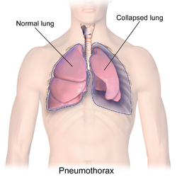 Pneumothorax.