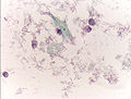 Cellule avec nombreuses bactéries de la flore de Doderlein.