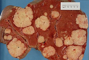 Зріз печінки з чисельними метастатичними вузлами раку підшлункової залози