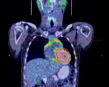 Aspect d'un thymome en TEP scanner avec une discrète hyperfixation.