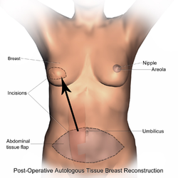 Post-operative state after breast reconstruction using autologous tissue (TRAM).