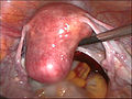 děloha před hysterektomií