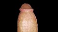 Glans Corona detailed in Circumcised Penis (dorsal view) (circumcision procedure at birth)