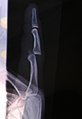 Lateral X-ray of left finger, showing proximal interphalangeal joint dislocation and fracture of the base of the middle phalanx