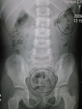 Рентгенограмма запора у ребёнка. Кругами отмечены каловые массы (фекалии — белым цветом, окружающий их кишечный газ — чёрным цветом)