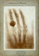 أول صورة طبية بالأشعة السينية في التاريخ (1895)