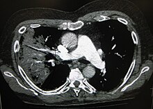 Чорно-білий знімок показує внутрішні органи у поперечному зрізі на знімку КТ. Там де слід очікувати чорне ліворуч, можна побачити білу область із чорними рисками, що проходять крізь неї.