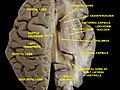 Human brain dissection, showing the thalamus. (View from above.)