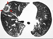 CT image of reversed halo sign in patient with organizing pneumonia.