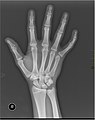 Sağ elin röntgen resmi