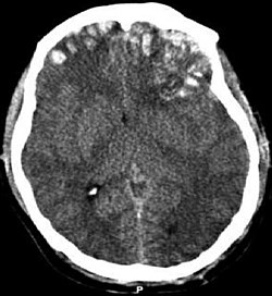 تصوير بالأشعة المقطعية لرضة دماغية يظهر نزفًا داخل القحف وورم دموي تحت الجافية وكسر الجمجمة[1]