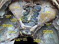 Ethmoid sinus. Ethmoidal air cells. Deep dissection. Superior view.