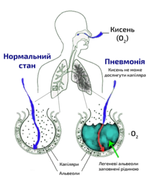 Схема легенів людини з порожньою окружністю праворуч, що представляє нормальну альвеолу, та іншою ліворуч, що показує альвеолу, заповнену рідиною, як при пневмонії