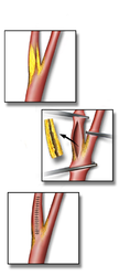 Endarterectomy.