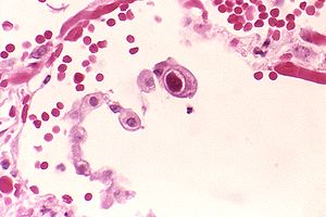 Typical "owl eye" inclusion indicating CMV infection of a lung pneumocyte